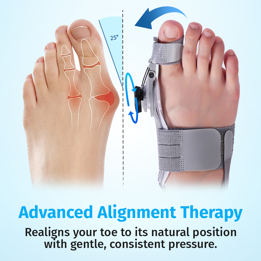 How to Fix Bunions Without Surgery How to Fix Bunions Without Surgery